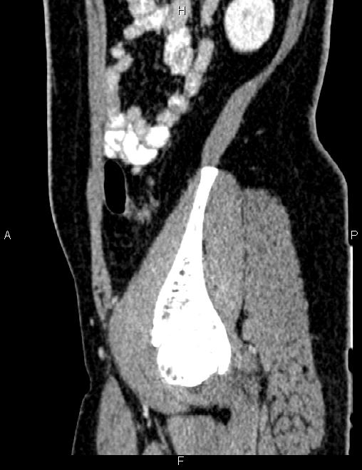 Bilateral ovarian teratoma (Radiopaedia 83131-97503 D 89).jpg