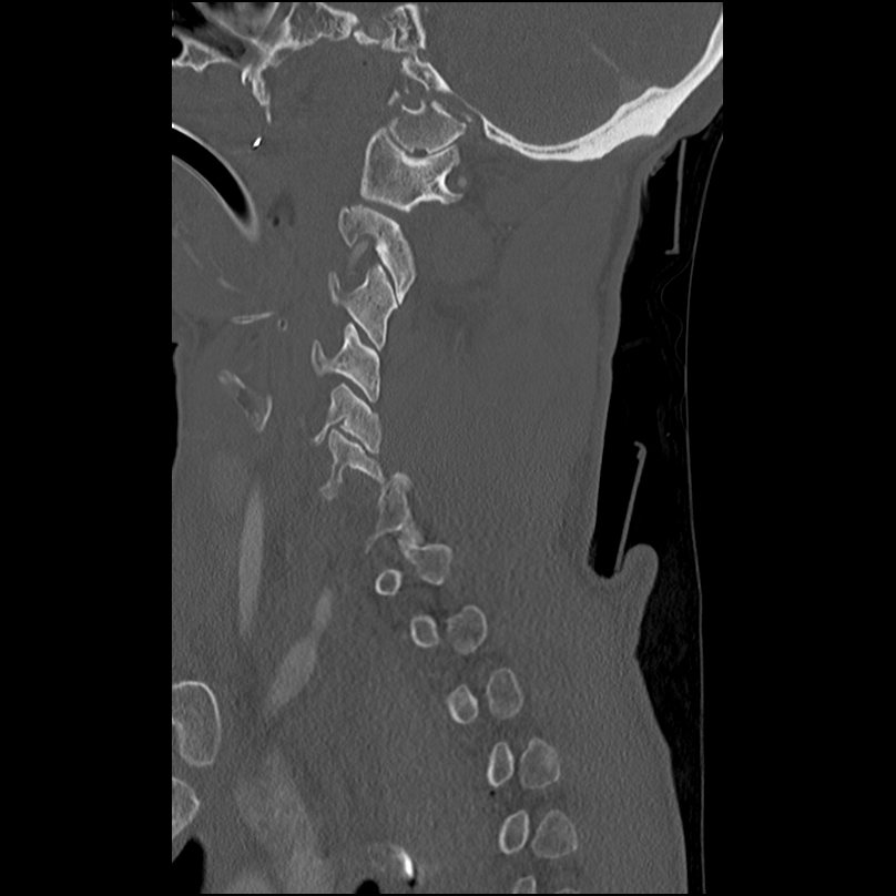 Bilateral perched facets with cord injury (Radiopaedia 45587-49713 Sagittal bone window 14).jpg