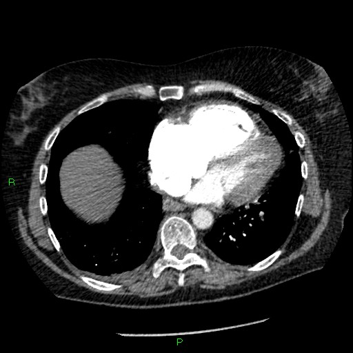 Bilateral pulmonary emboli (Radiopaedia 32700-33669 Axial C+ CTPA 77).jpg