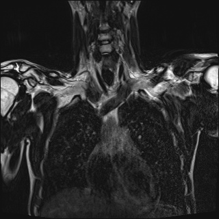 Bilateral spinoglenoid notch ganglion cysts (Radiopaedia 29577-30082 Coronal T2 41).jpg