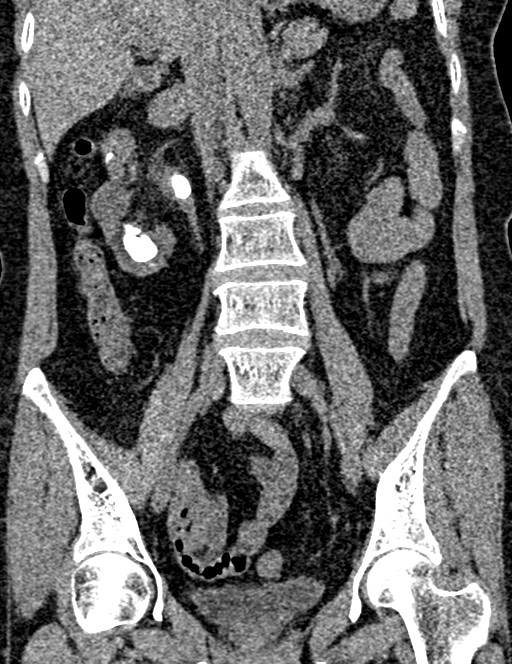 Bilateral staghorn calculi (Radiopaedia 59475-66842 Coronal non-contrast 60).jpg