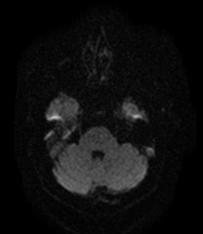 File:Bilateral thalamic glioma (Radiopaedia 65852-75009 Axial DWI 5).jpg