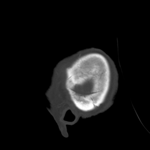 Biparietal osteodystrophy (Radiopaedia 46109-50463 Sagittal bone window 8).jpg