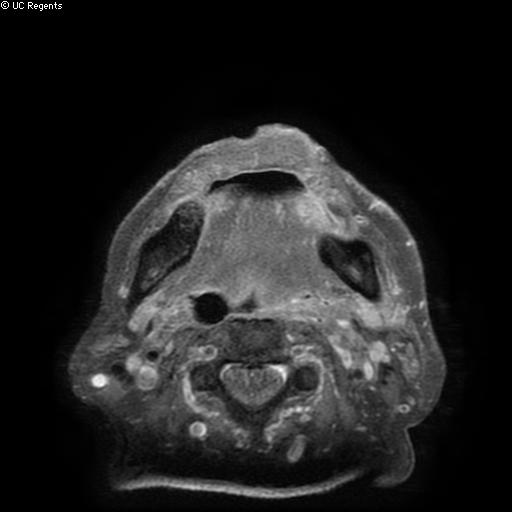 Bisphosphonate-related osteonecrosis of the maxilla (Radiopaedia 51367-57101 Axial T1 C+ fat sat 6).jpg