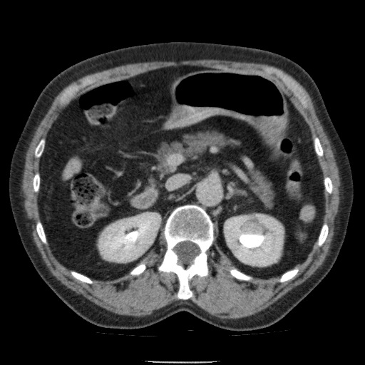 Bladder tumor detected on trauma CT (Radiopaedia 51809-57609 C 46).jpg
