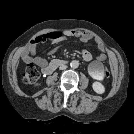 Bladder tumor detected on trauma CT (Radiopaedia 51809-57609 C 71).jpg