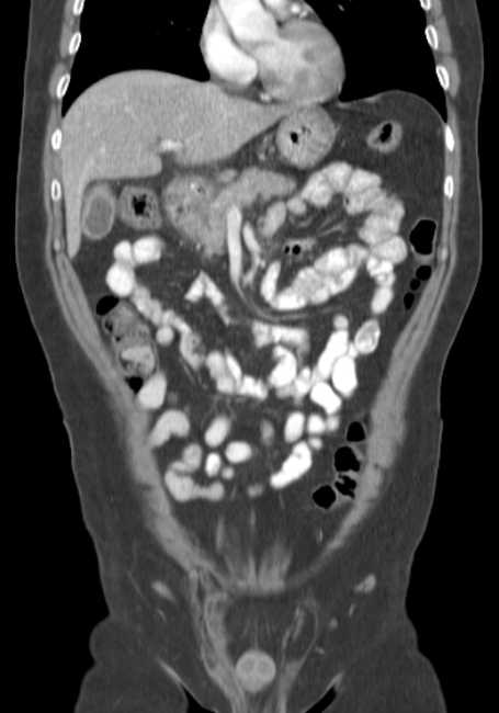 Bleeding duodenal ulcer and adenomyomatosis of gallbladder (Radiopaedia 61834-69861 B 57).jpg