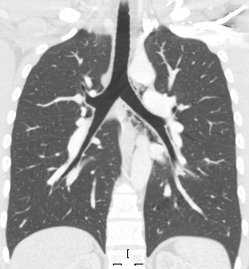 File:Blunt chest trauma - pulmonary interstitial emphysema and pneumomediastinum (Radiopaedia 20666-20552 Coronal lung window 1).jpg