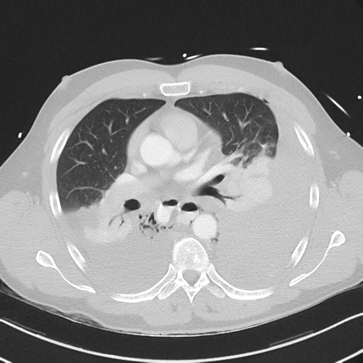 Boerhaave syndrome (Radiopaedia 39382-41661 Axial lung window 27).png