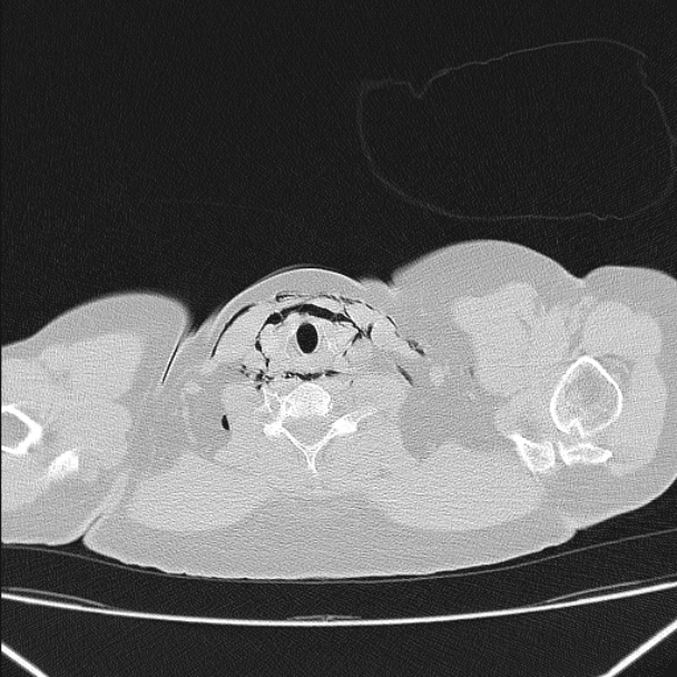 Boerhaave syndrome (Radiopaedia 45644-49799 Axial lung window 18).jpg