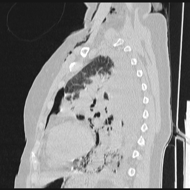 Boerhaave syndrome (Radiopaedia 45644-49799 Sagittal lung window 55).jpg