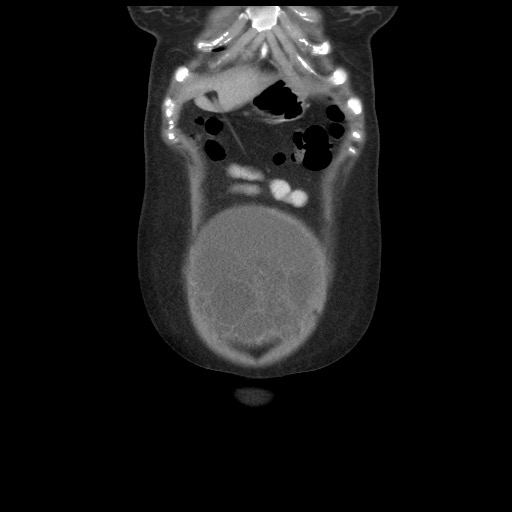 File:Borderline mucinous tumor (ovary) (Radiopaedia 78228-90808 C 10).jpg