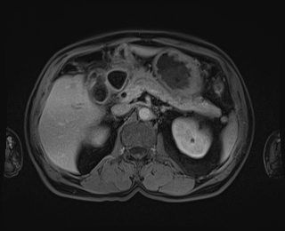 Bouveret syndrome (Radiopaedia 61017-68856 Axial T1 C+ fat sat 33).jpg