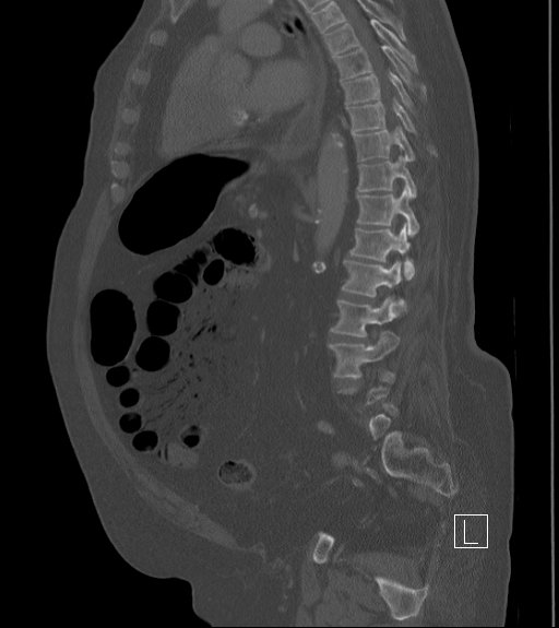 File:Bowel ischemia secondary to SMA occlusion with extensive portomesenteric venous gas (Radiopaedia 54656-60871 Sagittal bone window 46).jpg