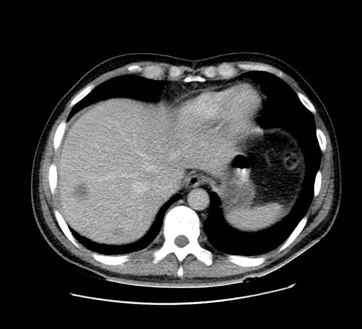 Bowel obstruction from colon carcinoma (Radiopaedia 22995-23028 A 11).jpg