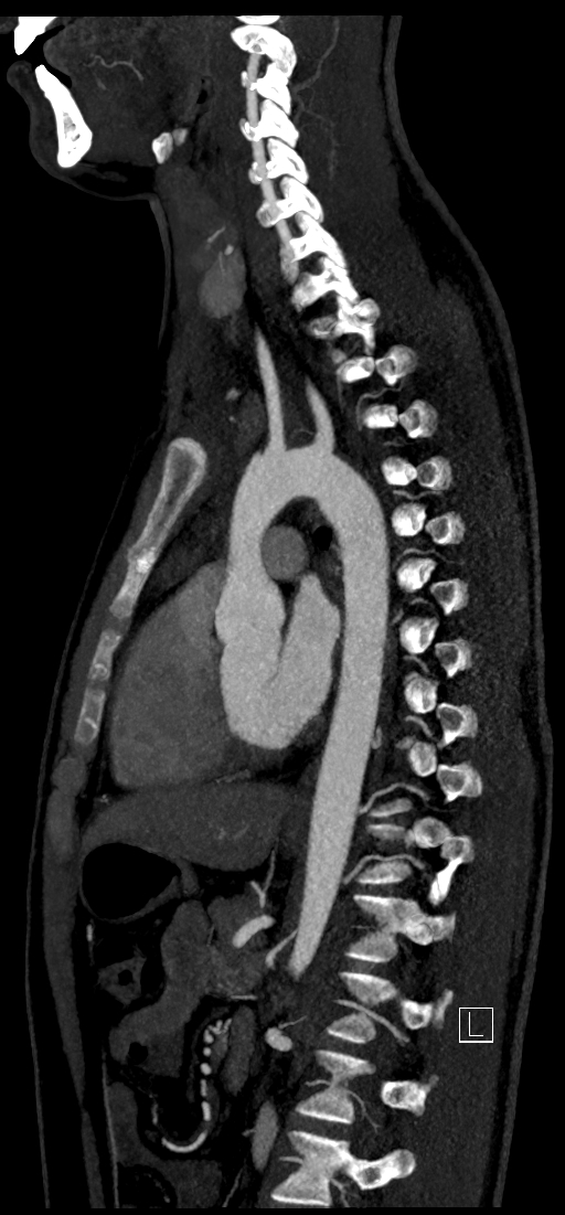 Brachiocephalic trunk pseudoaneurysm (Radiopaedia 70978-81191 C 55).jpg
