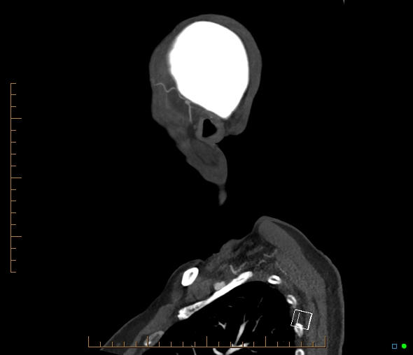 Brachiocephalic trunk stenosis (Radiopaedia 87242-103519 C 2).jpg
