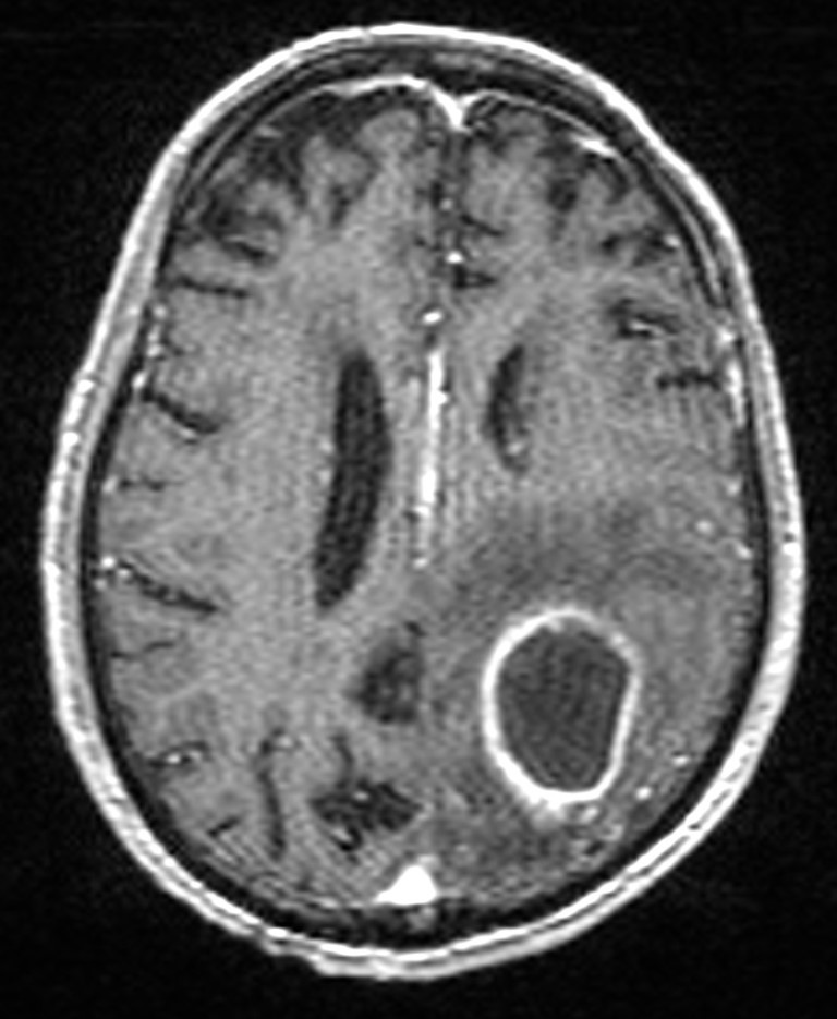 Brain abscess with dual rim sign (Radiopaedia 87566-103938 Axial T1 C+ 108).jpg