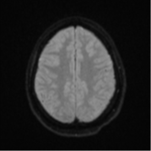 Brain death (Radiopaedia 43754-47237 Axial DWI 20).png