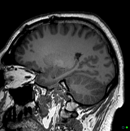 Brain death on MRI and CT angiography (Radiopaedia 42560-45689 Sagittal T1 48).jpg