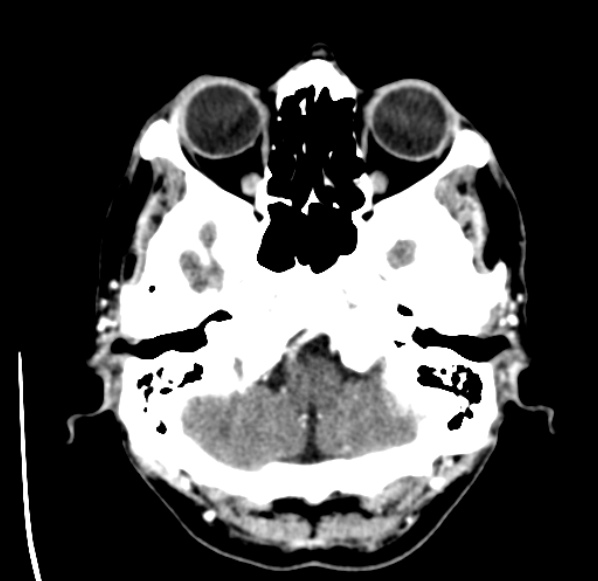 File:Brain metastases from lung cancer (Radiopaedia 24480-24781 Axial C+ delayed 6).jpg
