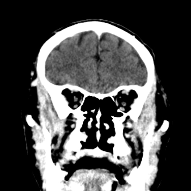 Brain metastases from lung cancer (Radiopaedia 27849-28092 Coronal C+ delayed 16).jpg