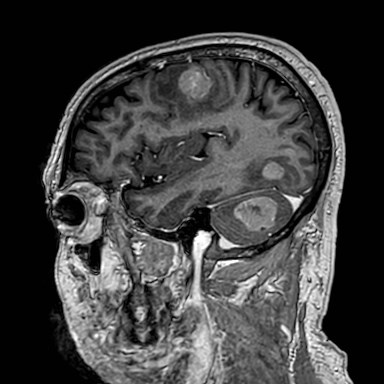 Brain metastases from lung cancer (Radiopaedia 83839-99028 Sagittal T1 C+ 49).jpg