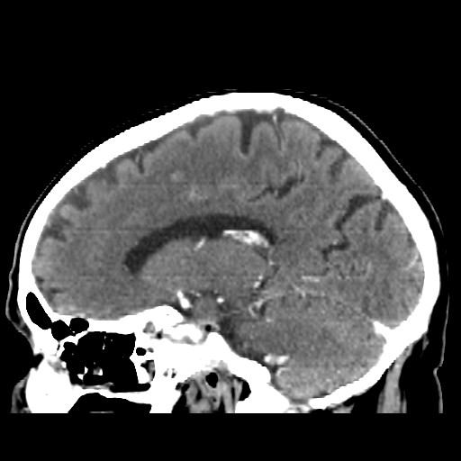 Brain metastasis (Radiopaedia 42617-45760 D 21).jpg