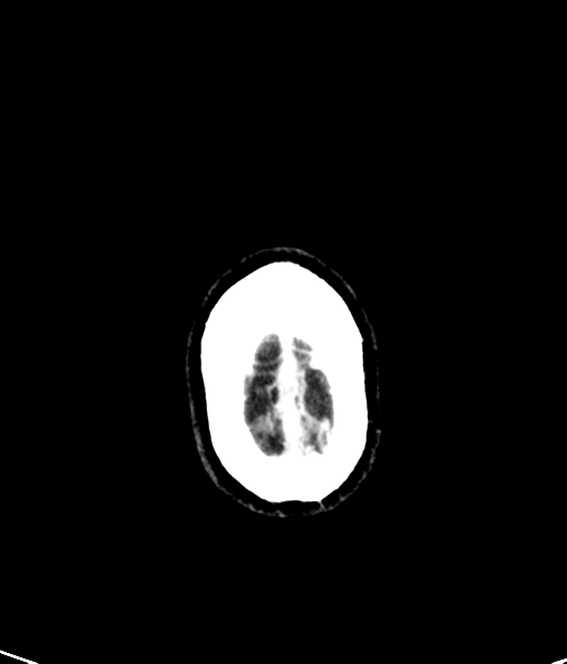 Brain metastasis (large cystic mass) (Radiopaedia 47497-52106 Axial C+ 54).png