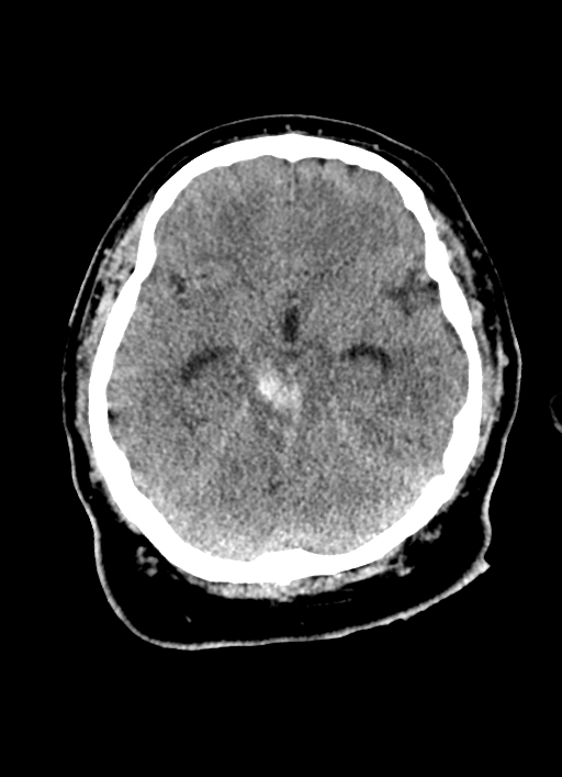 Brainstem hemorrhage (Radiopaedia 81294-94976 Axial non-contrast 39).jpg