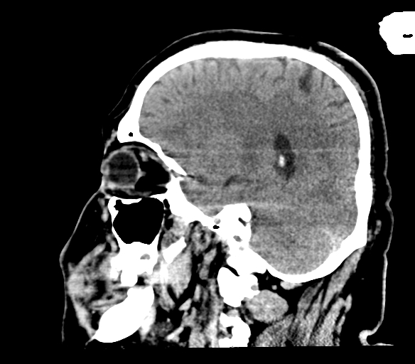 File:Brainstem hemorrhage (Radiopaedia 81294-94976 C 39).jpg