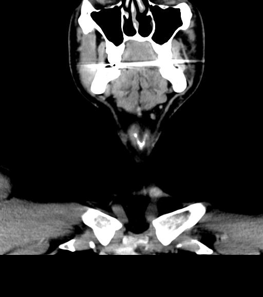 Branchial cleft cyst (Radiopaedia 31167-31875 Coronal C+ delayed 20).jpg