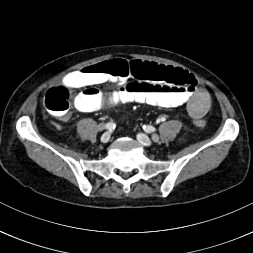 File:Broad ligament hernia (Radiopaedia 84802-100276 A 66).jpg