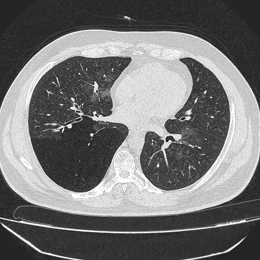 File:Bronchial atresia (Radiopaedia 58271-65417 Axial lung window 28).jpg