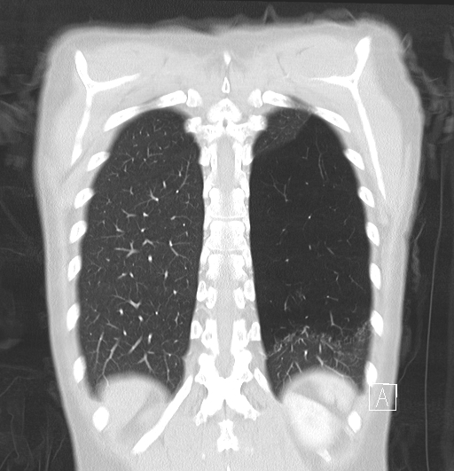 File:Bronchial atresia (Radiopaedia 73677-84470 Coronal lung window 29).jpg