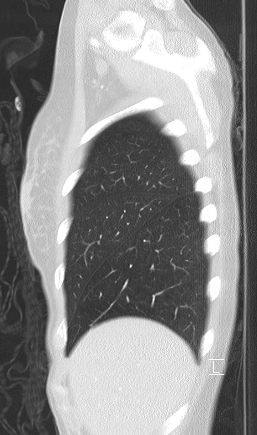 Bronchial atresia (Radiopaedia 73677-84470 Sagittal lung window 7).jpg