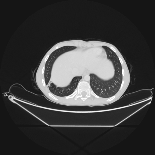 Bronchial carcinoid tumor (Radiopaedia 57187-64090 Axial lung window 65).jpg