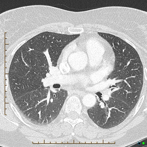 Bronchial diverticula (Radiopaedia 79512-92676 Axial lung window 93).jpg