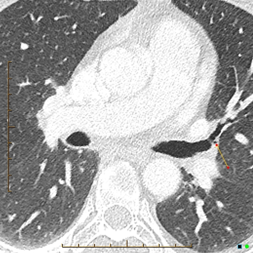 File:Bronchial diverticula (Radiopaedia 79512-92677 Axial lung window 10).jpg