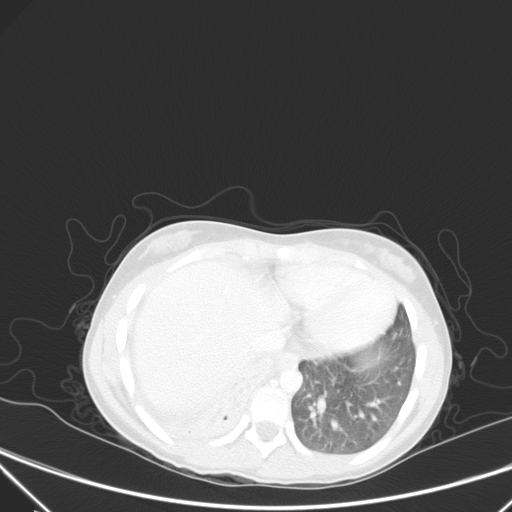 Bronchial mucoepidermoid carcinoma (Radiopaedia 57023-63895 Axial lung window 86).jpg