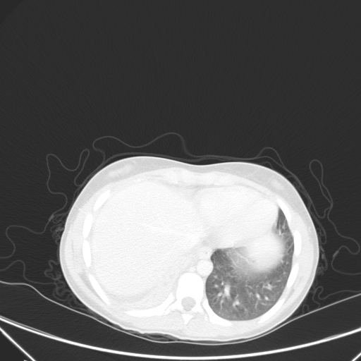 Bronchial mucoepidermoid carcinoma (Radiopaedia 57023-63895 Axial lung window 90).jpg