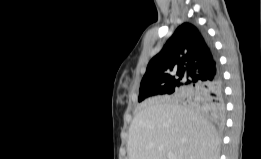 Bronchial mucoepidermoid carcinoma (Radiopaedia 57023-63895 Sagittal 55).jpg