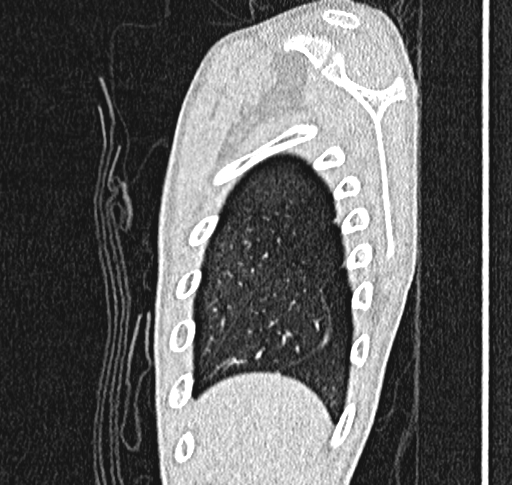 Bronchiolitis obliterans (Radiopaedia 71538-81897 Sagittal lung window 4).jpg