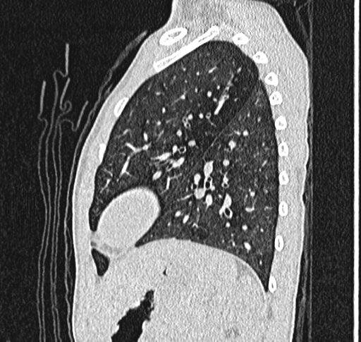 File:Bronchiolitis obliterans (Radiopaedia 71538-81897 Sagittal lung window 51).jpg