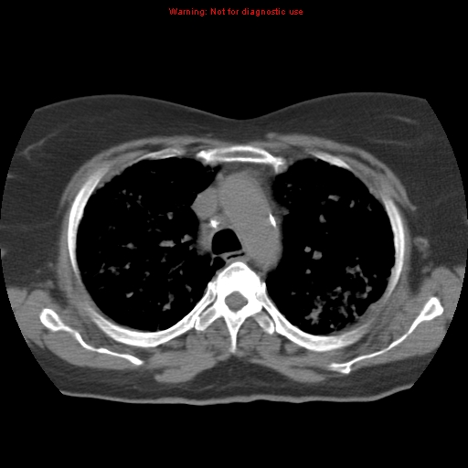 Bronchoalveolar carcinoma (Radiopaedia 13224-13233 Axial non-contrast 15).jpg