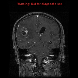 File:Bronchogenic carcinoma brain metastasis (Radiopaedia 9286-9969 Coronal T1 9).jpg