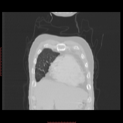 File:Bronchogenic carcinoma with left atrial large deposit - T4N3M1a (Radiopaedia 42316-45428 Coronal lung window 2).jpg