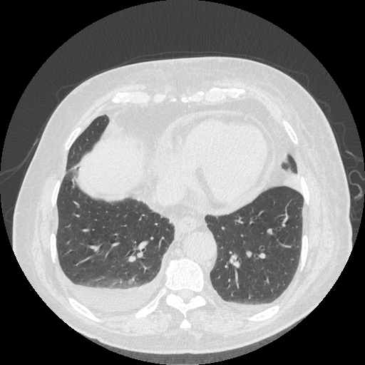 File:Bronchogenic carcinoma with metastatic lymphadenopathy (Radiopaedia 37671-39569 Axial lung window 41).jpg