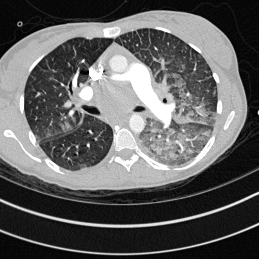 Bronchogenic cyst (Radiopaedia 77801-90071 Axial lung window 25).jpg