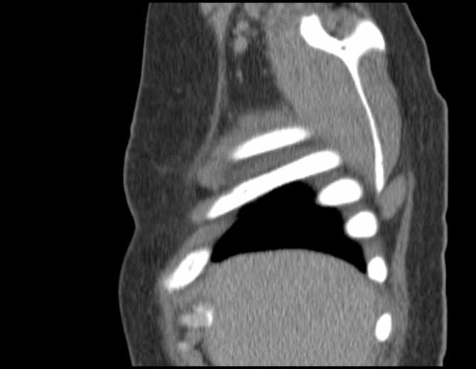 Brown tumors compressing the spinal cord (Radiopaedia 68442-77988 B 10).jpg